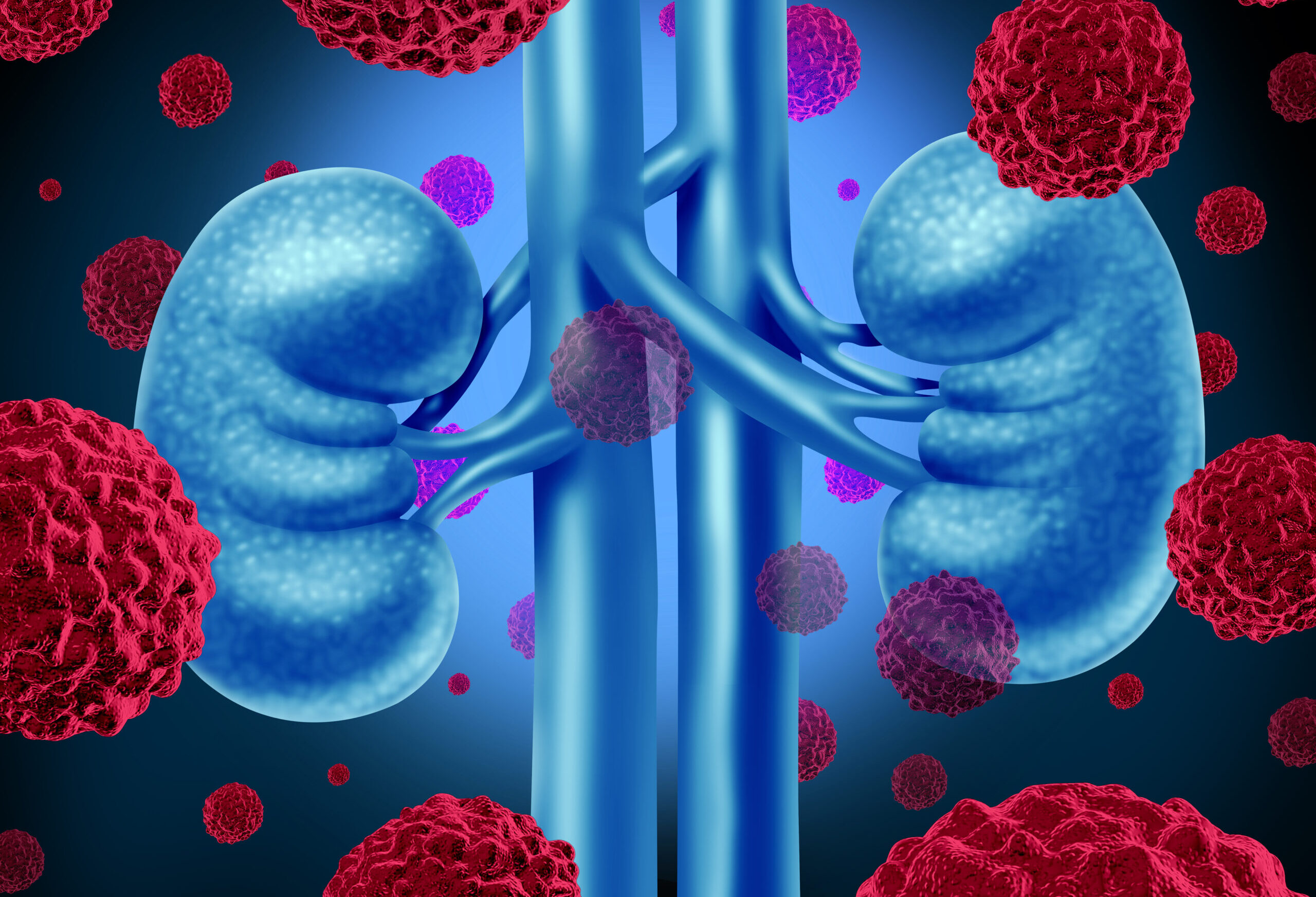 Terapia personalizată cu celule T induce remisia completă a cancerului renal metastazic