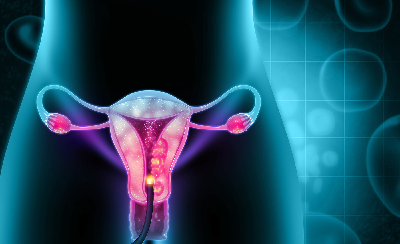 Bacteriile Specifice din Intestin Legate de Endometrioză
