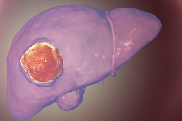 Testul de Sânge Care Sporește Detectarea Timpurie a Cancerului de Ficat