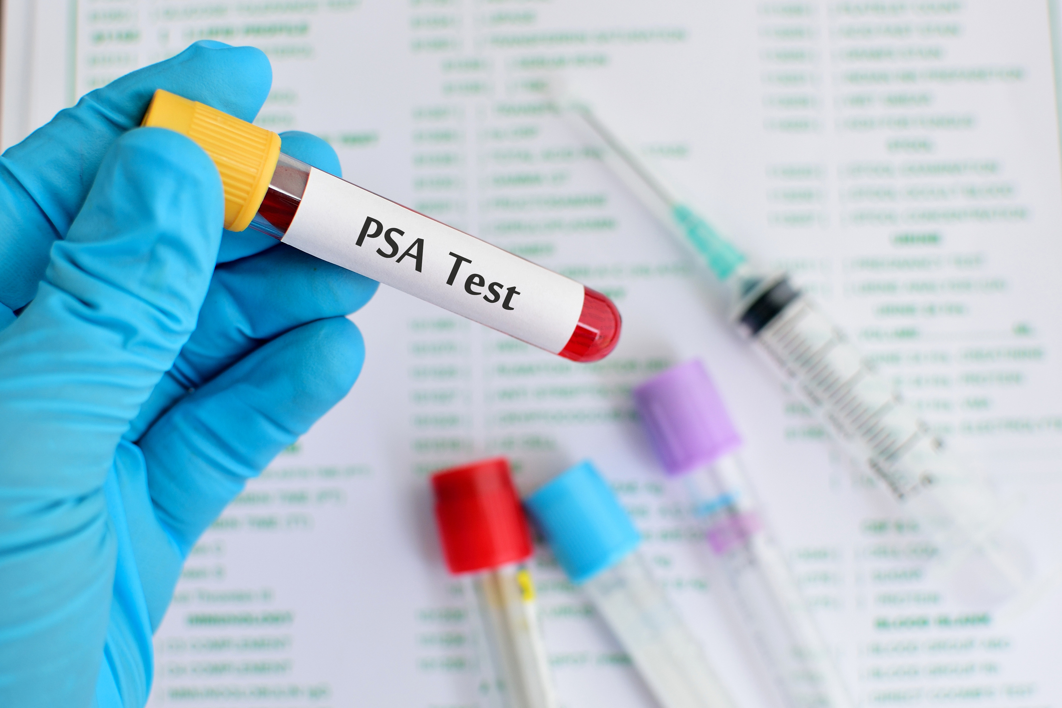 Indicatorul PSA care prezice cel mai bine supraviețuirea în cancerul de prostată metastatic identificat