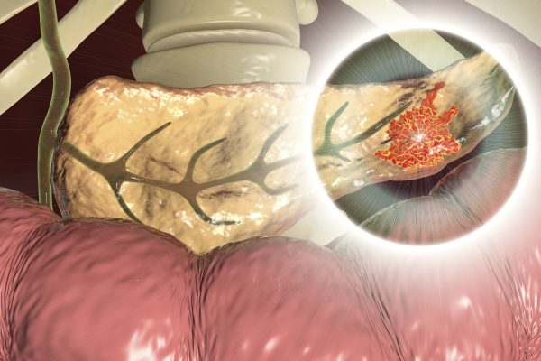 Riscul de Cancer Pancreatic, Cuantificat mai Bine prin Caracteristicile Chisturilor Pancreatice