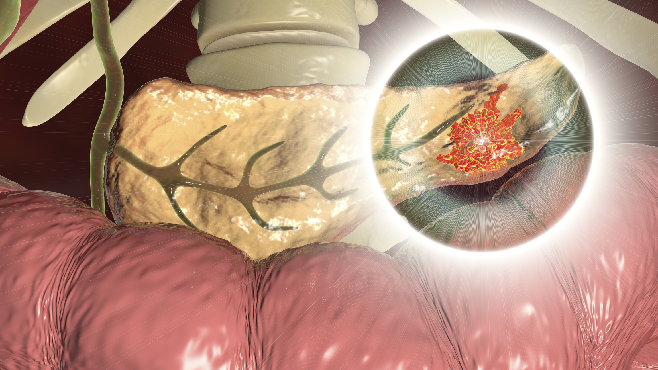 Riscul de Cancer Pancreatic, Cuantificat mai Bine prin Caracteristicile Chisturilor Pancreatice