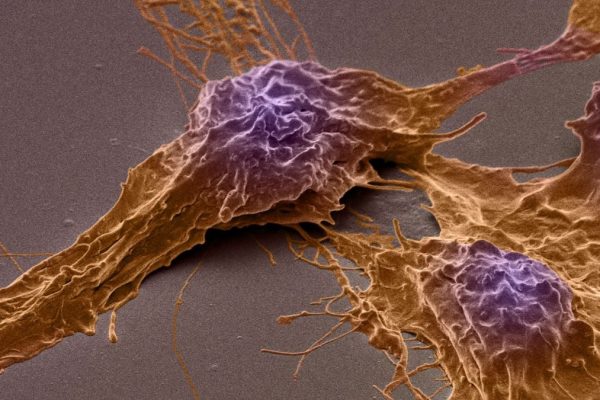Cum Cancerul Mortal al Creierului Își Folosește Activitatea Creierului pentru a-și Stimula Creșterea, Arată un Studiu