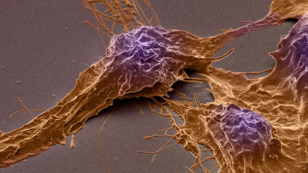 Cum Cancerul Mortal al Creierului Își Folosește Activitatea Creierului pentru a-și Stimula Creșterea, Arată un Studiu