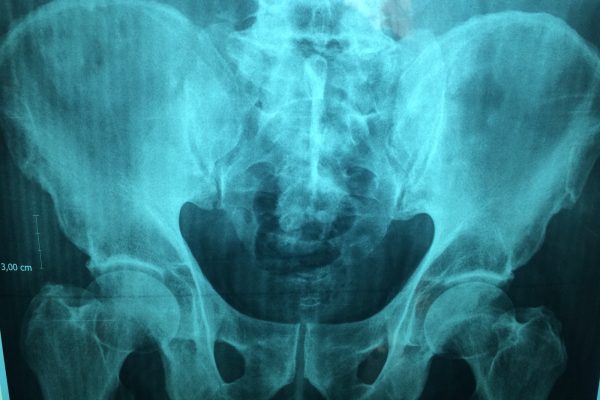 Algoritmul AI, mai bun decât metodele actuale de screening pentru riscul de fractură de șold
