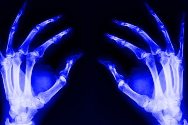 Cum îmbătrânirea osoasă poate afecta întregul organism
