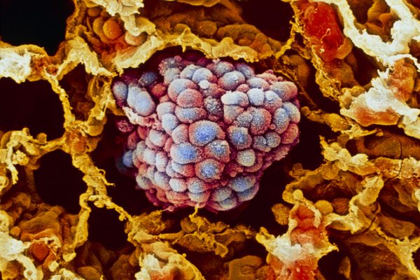 Inteligența Artificială Depășește PD-L1 în Prognozarea Rezultatelor Imunoterapiei în Cancerul Pulmonar