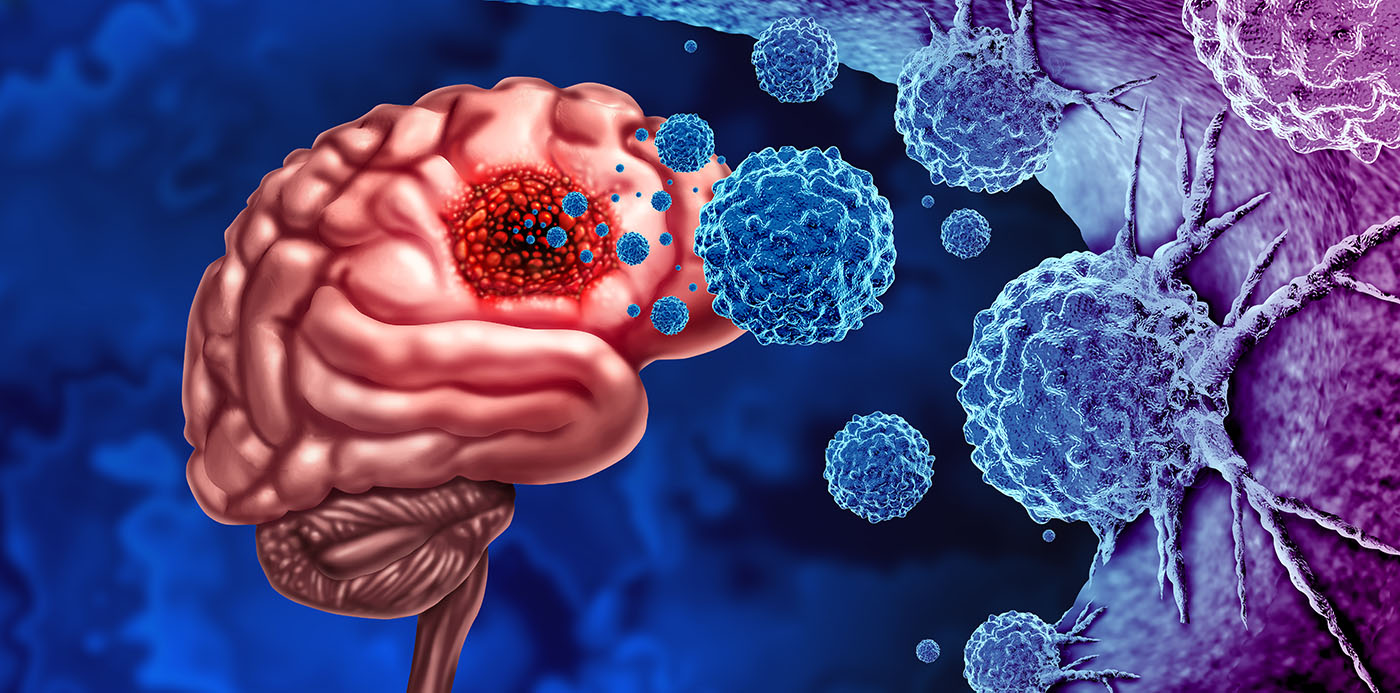 Cum Neuroni Inhibitori Pot Controla Tumorile Cerebrale Gliomatoase la Adulți