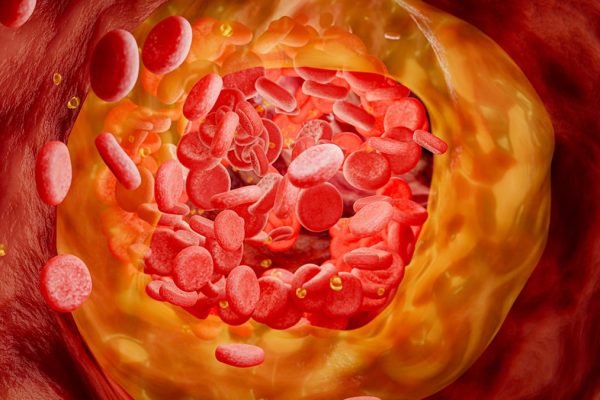 Tratamentul experimental cu o singură doză reduce colesterolul „rău” cu 52% în primul studiu uman