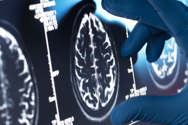 Descoperire Științifică: Alzheimerul Amenință dincolo de Creier, arată un Studiu