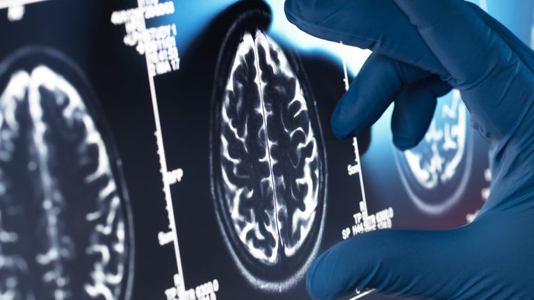 Descoperire Științifică: Alzheimerul Amenință dincolo de Creier, arată un Studiu