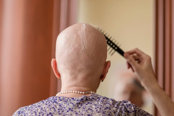Medicamentul pentru artrită redă până la 100% din părul pacienților cu alopecie severă