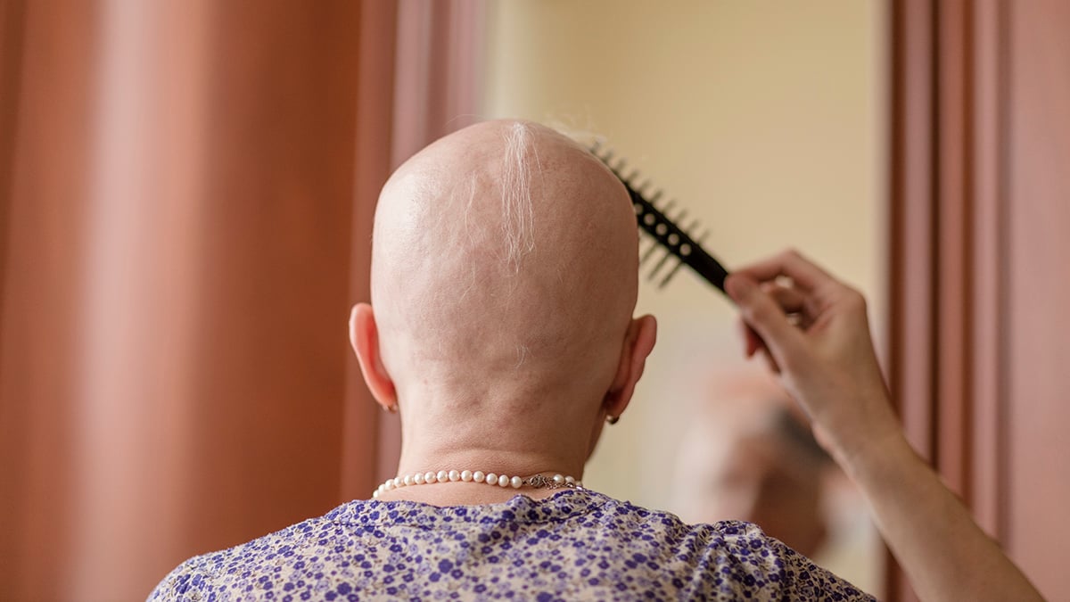 Medicamentul pentru artrită redă până la 100% din părul pacienților cu alopecie severă