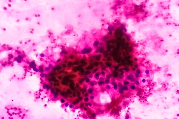 Cercetătorii au descoperit celule cu nucleu gigant asociate cu cancerul incipient și rezistența la ferroptoză