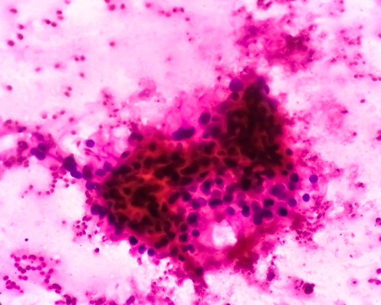 Cercetătorii au descoperit celule cu nucleu gigant asociate cu cancerul incipient și rezistența la ferroptoză