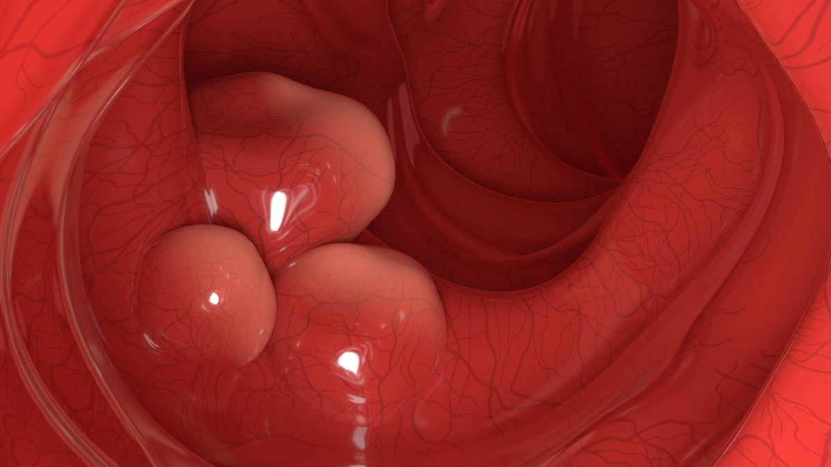 Bacteriile Probiotice Modificate Genetic Elimină 43% din Tumorile Colo-rectale la Șoareci