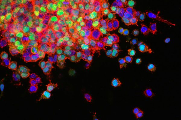 Terapie Celulară Experimentală: Cancerul Metastazic al unui Băiețel de Trei Ani Dispare După Două Injecții