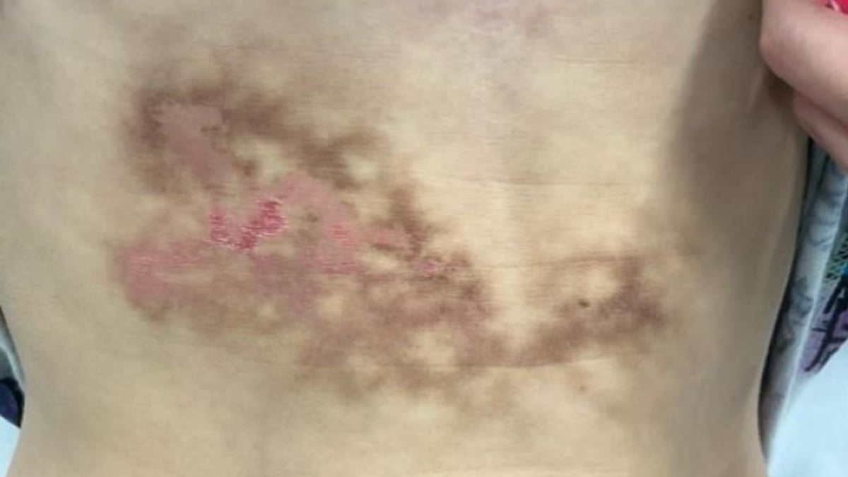 O Erupție Bizară, Confundată inițial cu o Afecțiune Hepatică, dar cauzată de un Obicei Comun