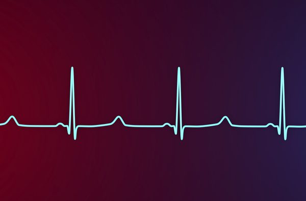 Descoperire importantă în ceea ce privește riscul de Sindrom QT Lung datorat hărțuirii genetice a variantelor genei KCNQ1