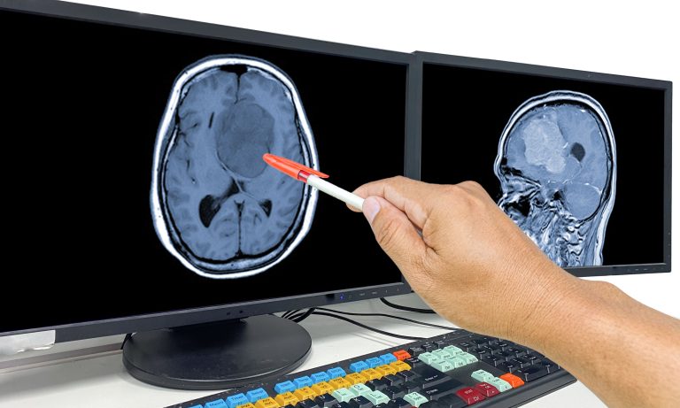 Terapia Combinată Depășește Obstacolele Cheie ale Imunoterapiei pentru Glioblastom