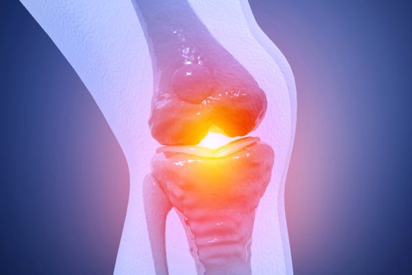 Medicament aprobat de FDA ar putea fi reutilizat pentru ameliorarea durerii în caz de osteoartrită și protejarea cartilajului