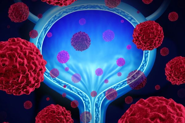 Testul cu Urină pentru ARN Ar Putea Detecta Cancerul de Vezică și Prezice Răspunsul la Tratament