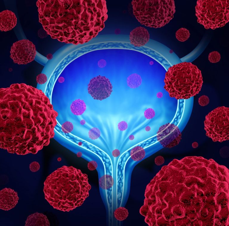Testul cu Urină pentru ARN Ar Putea Detecta Cancerul de Vezică și Prezice Răspunsul la Tratament