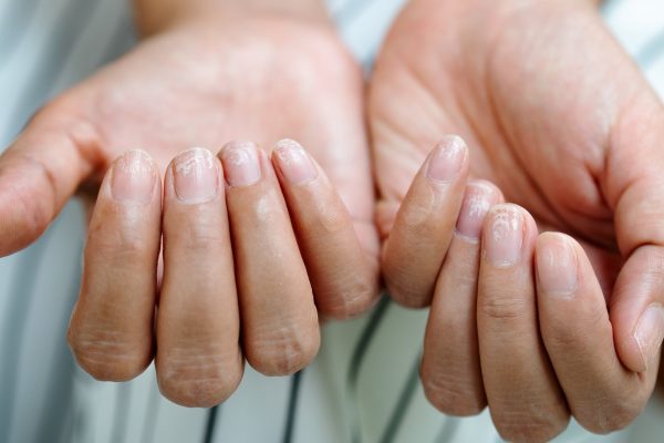 Utilizatorii de GLP-1 raportează că unghiile li se desprind
